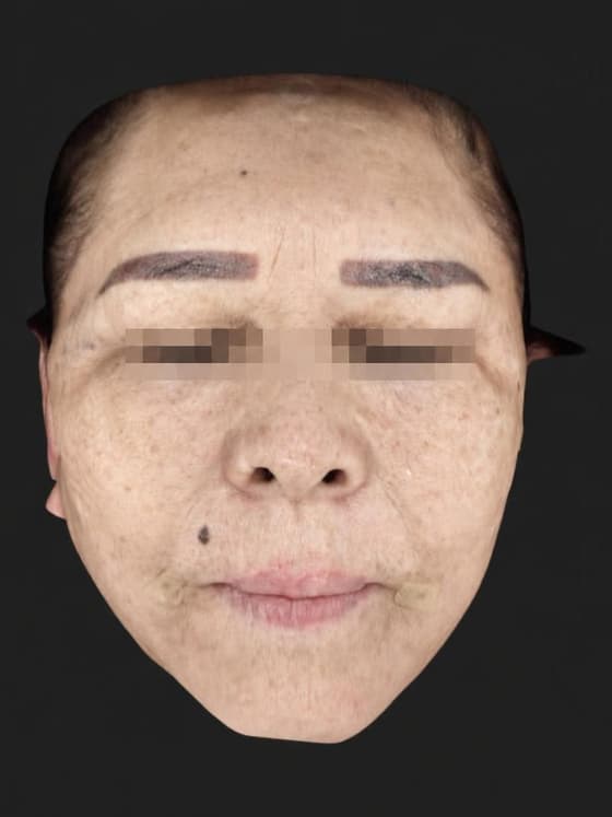 Front view after treatment — the same patient treated at Cellinique