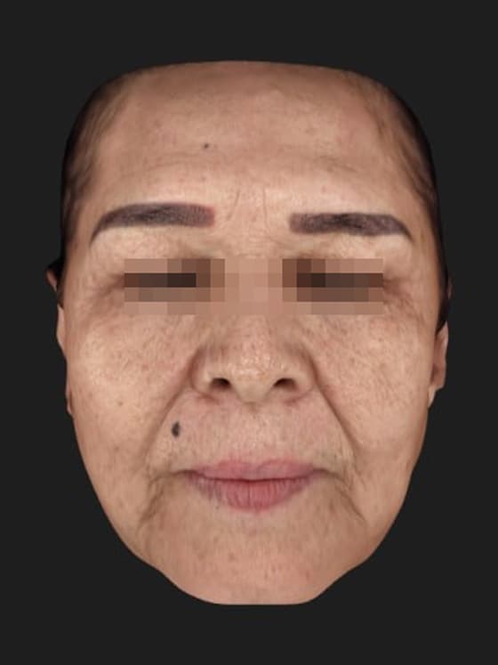 Front view before treatment — the same patient treated at Cellinique