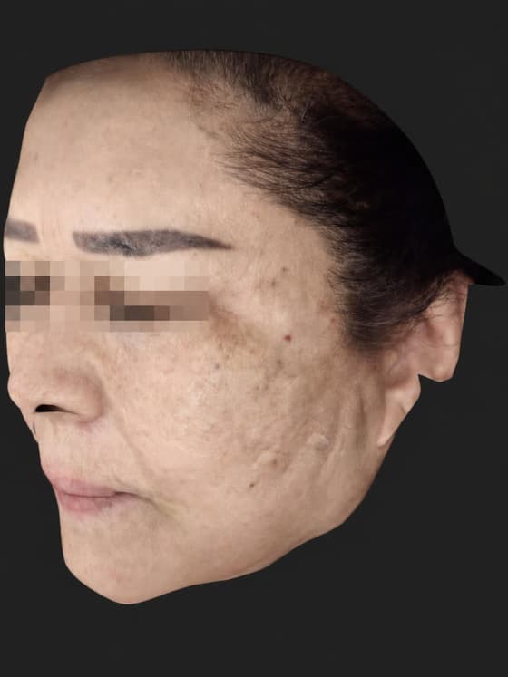 Right 45° view after treatment — the same patient treated at Cellinique