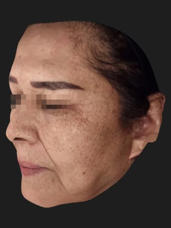 Right 45° view before treatment — the same patient treated at Cellinique