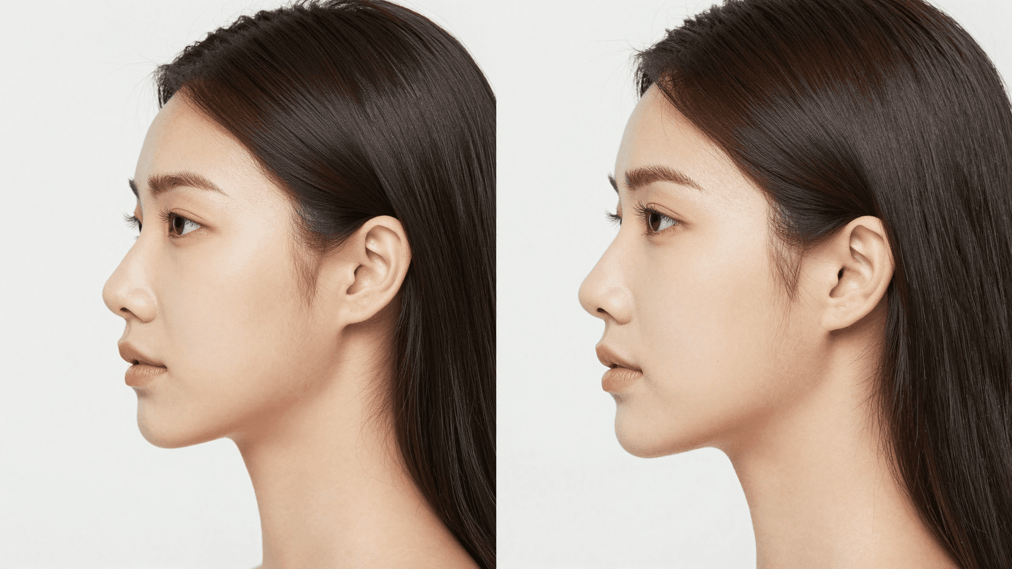 서울 리프팅 시술 종합 가이드: 울쎄라부터 실리프팅까지